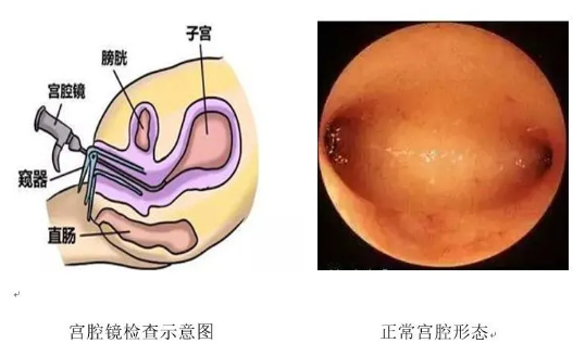 做宮腔鏡要住院嗎