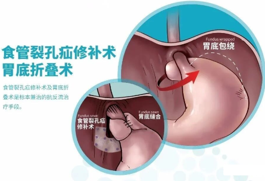 腹腔鏡下胃底折疊術