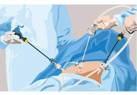腹腔鏡是大手術嗎