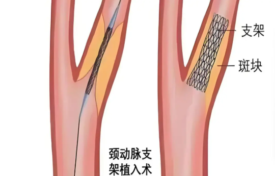 頸動脈支架植入術