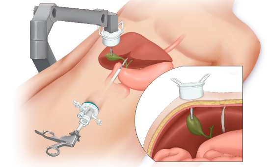 腹腔鏡膽囊切除術(shù)英文