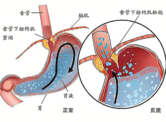 反流性食管炎和胃食管反流是一個(gè)病嗎