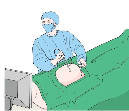 做完腹腔鏡