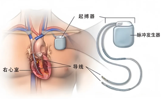 心臟起搏器是什么