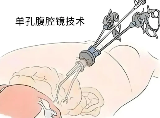 子宮摘除手術(shù)是微創(chuàng)還是開腹