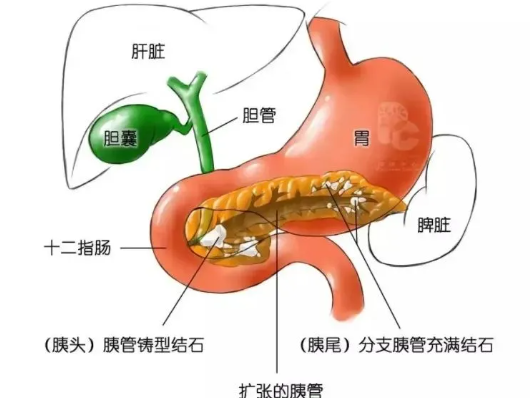 主胰管結(jié)石
