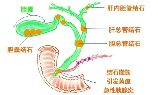 胰腺管結(jié)石