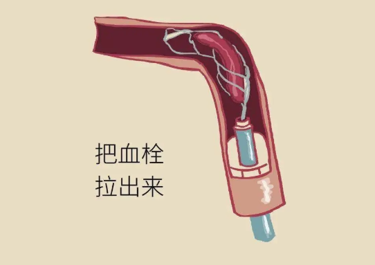 腦血管堵塞治療方法