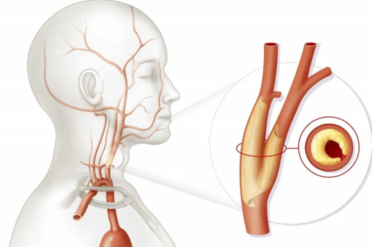 頸動(dòng)脈支架的三個(gè)害處