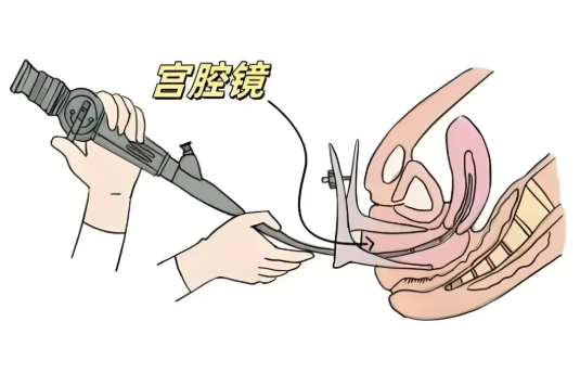 宮腔鏡檢查過程痛苦嗎