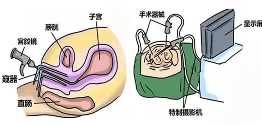 子宮縱隔是個(gè)小手術(shù)嗎
