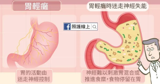 胃輕癱是怎么引起的