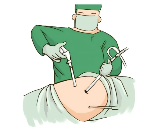 腹腔鏡膽囊切除術(shù)后并發(fā)癥