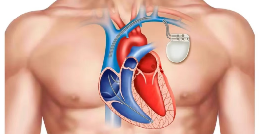 安裝心臟起搏器是大手術(shù)嗎
