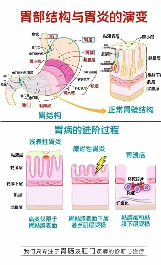 北京豐益橋醫(yī)院胃腸鏡工作站 胃炎的演變過程——憋一憋是過不去的！