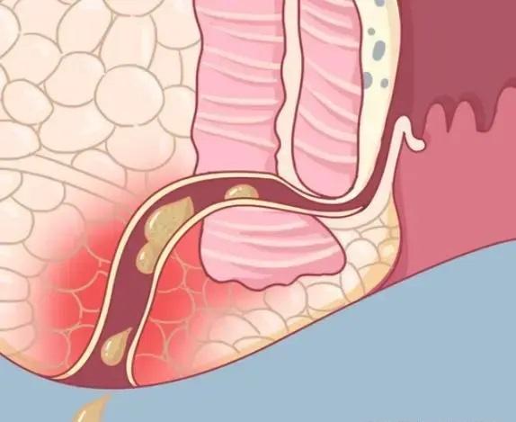 治肛瘺北京哪家醫(yī)院好？肛瘺早期有哪些主要癥狀？