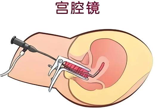 宮腔鏡手術要住院嗎