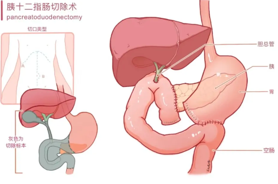 胰十二指腸切除護(hù)理查房