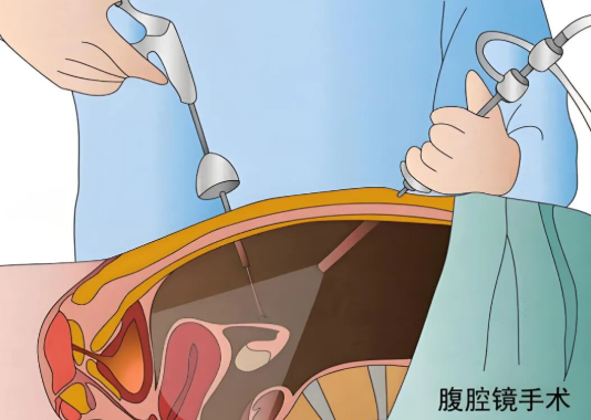 腹腔鏡子宮全切手術(shù)