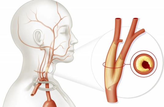 頸動(dòng)脈支架一般能維持幾年