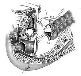 北京2026年腸癌早篩季度 腸息肉能不能治好？