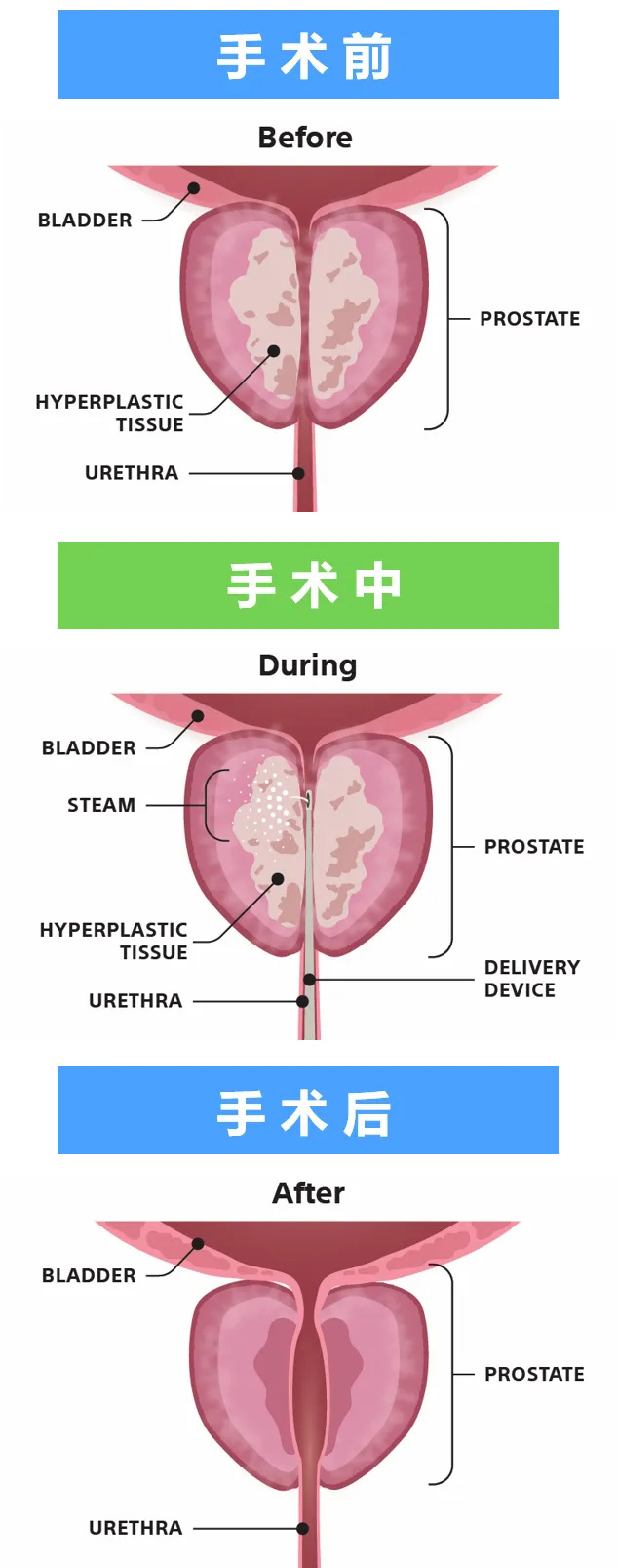 紅河前列腺增生診療：瑞夢熱蒸汽消融術(shù)，超微創(chuàng)不開刀，助力快速康復！